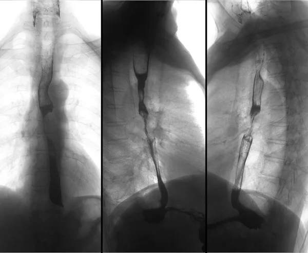 X-ray of the upper gastrointestinal series (UGI) with barium. Cancer of the esophagus. Negative. Radiology of the upper gastrointestinal series (UGI) with barium. Cancer of the esophagus.