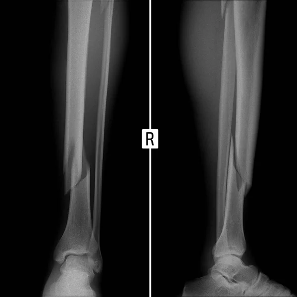 左のすねの両方の骨の破壊の 線します Negative Radiology 上部と下部セクションの左脛の両方の骨の破壊 — ストック写真