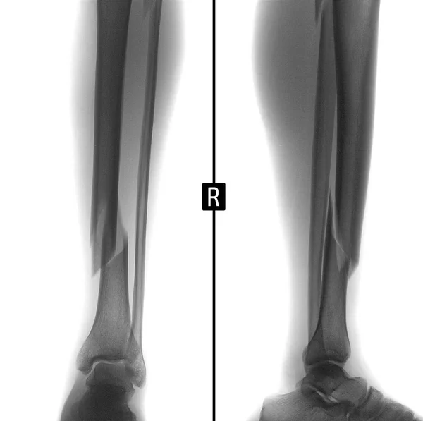 Ray Fractuur Van Beide Botten Van Linker Scheenbeen Radiologie Fractuur — Stockfoto