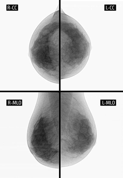 X-ray picture Mammography. Small calcinates. ancer. Negative.Radiography of mammary glands. Small points calcinates in the upper-outer quadrant of the left mammary gland.
