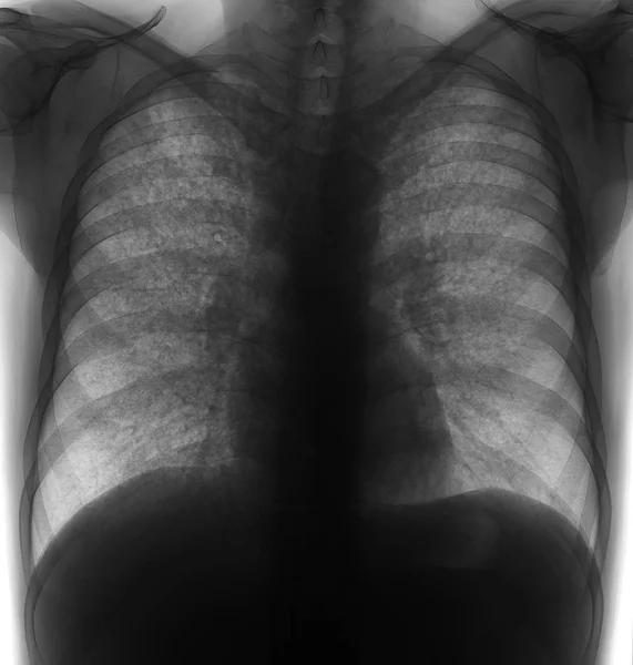 Rentgen Plic Miliární Tuberkulóza Negativní Malé Skvrny Všech Oblastech — Stock fotografie