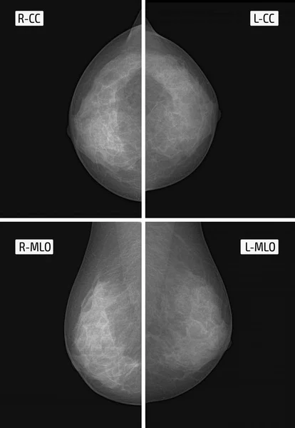 X-ışını resim mamografi. Küçük calcinates. Ancer. Meme dokuları radyografi. Sol meme bezinin üst dış kadranda küçük puan calcinates.