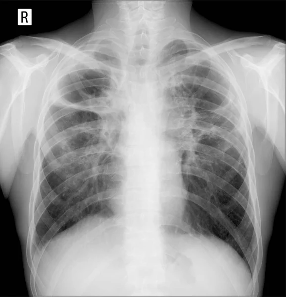 Rentgen Plic Plicní Fibróza Zaúčtovat Tuberkulózy — Stock fotografie
