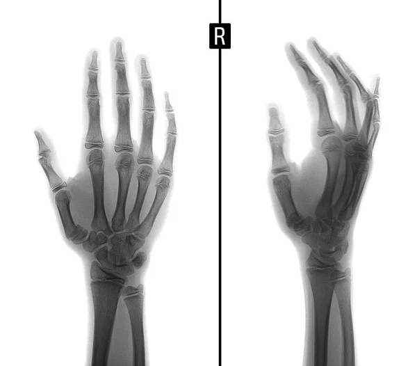 Рентген Руки Перелом Основания Пястной Кости Отрицательно — стоковое фото