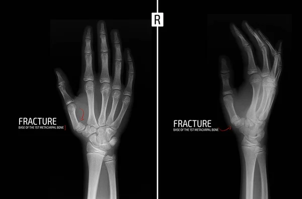 Röntgenfoto Van Hand Fractuur Van Basis Van Het 1Ste Metacarpale — Stockfoto