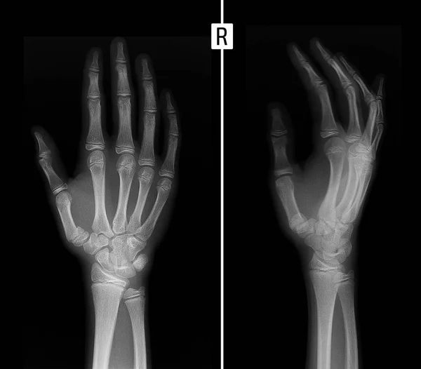 Radiografía Mano Fractura Base Del Primer Hueso Metacarpiano — Foto de Stock