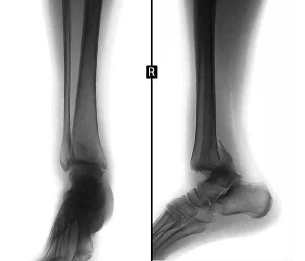 Rayos Espinilla Fractura Tobillo Borde Posterior Tibia Luxación Del Pie — Foto de Stock