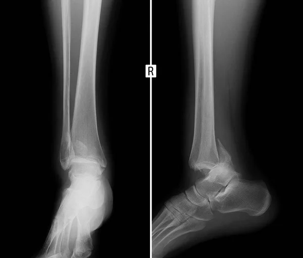 Rayos Espinilla Fractura Tobillo Borde Posterior Tibia Luxación Del Pie — Foto de Stock