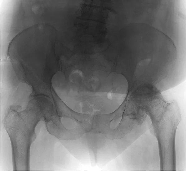 Radiografía Pelvis Artrosis Deformante Del Lado Izquierdo Necrosis Aséptica Cabeza — Foto de Stock