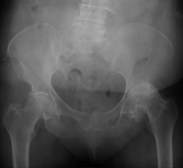 Radiografía Pelvis Artrosis Deformante Del Lado Izquierdo Necrosis Aséptica Cabeza —  Fotos de Stock