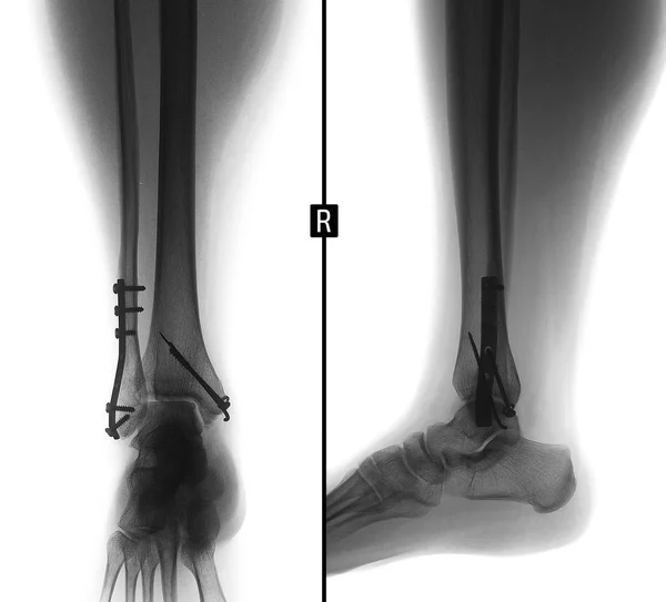 Рентген Голени Консолидированный Перелом Лодыжек Металлом Отрицательно — стоковое фото