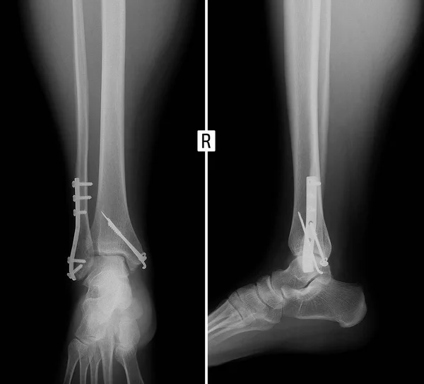 Rayos Espinilla Fractura Consolidada Tobillos Con Metal — Foto de Stock