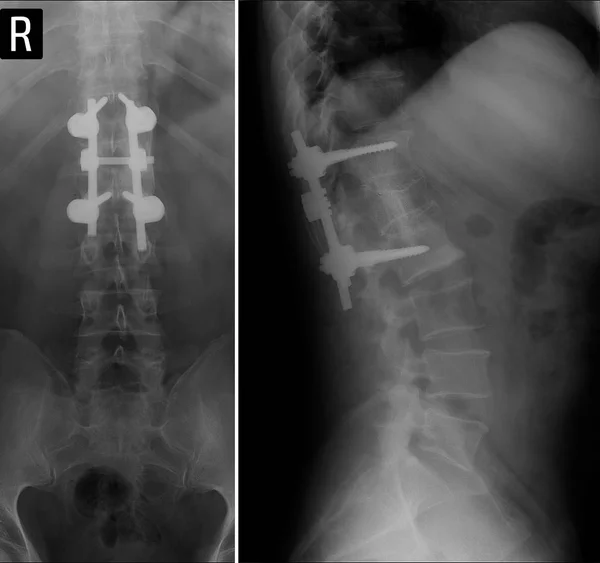 Radiografia Coluna Lombar Fratura Por Compressão Corpo Vertebral Fusão Coluna — Fotografia de Stock