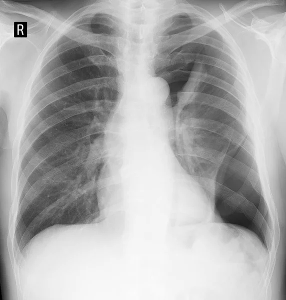 Akciğer röntgeni. Travma sonrası collabated akciğer sol. Sert akciğer. 