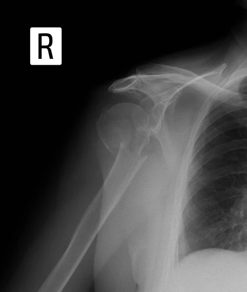 X-ray of the shoulder. Fracture-dislocated shoulder.