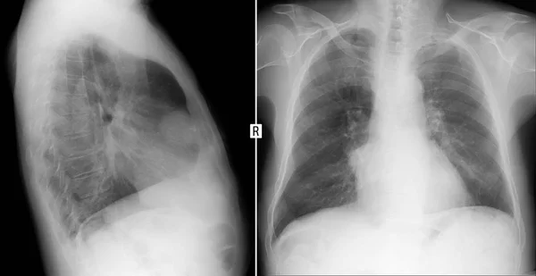 Röntgen Der Lungen Volumenbildung Des Mediastinums Teratome — Stockfoto