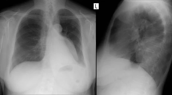 Röntgen Der Lungen Volumenbildung Des Mediastinums Enterogene Zyste — Stockfoto