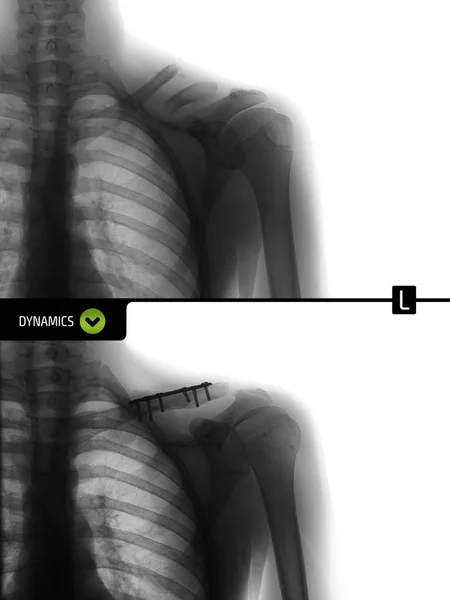 Sol Köprücük Röntgeni Metal Yapı Sonraki Fiksasyonu Negatif — Stok fotoğraf