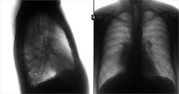 Рентген Легких Бронхопневмония Права Лимфаденопатия Отрицательно — стоковое фото