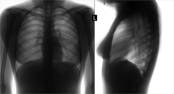 Röntgen Der Lungen Lungenentzündung Links Negativ — Stockfoto