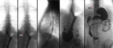 Baryum ile üst gastrointestinal sistem (Ugi) röntgen. Hiatal fıtık. Olumsuz. Marker.