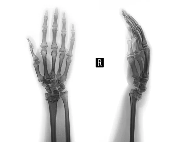 Radiografía Articulación Muñeca Fractura Del Radio Negativo — Foto de Stock