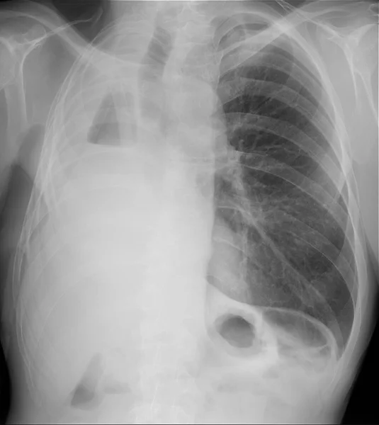 Røntgen Lungene Høyre Sidig Pneumonektomi – stockfoto