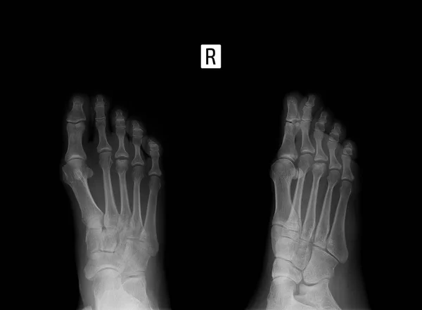 Рентген Стопы Остеохондропатия Плюсневой Кости — стоковое фото