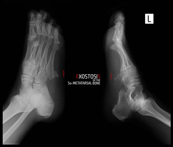 Рентген Стопы Экзостоз Пятой Плюсневой Кости Маркер — стоковое фото