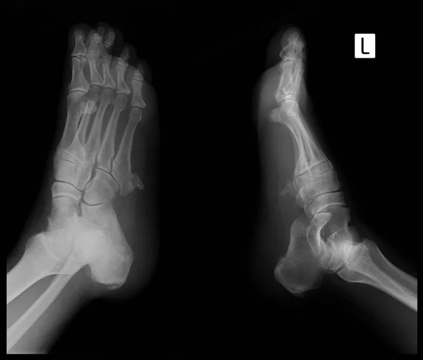 Röntgen Láb Lábközépcsont Csont Exosztózist — Stock Fotó