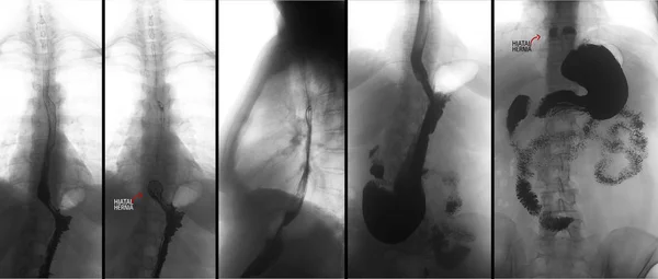 Radiographie Tractus Gastro Intestinal Supérieur Igu Avec Baryum Hernie Hiatale — Photo