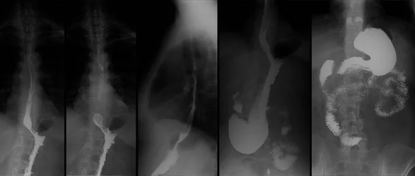 Sinar Dari Saluran Pencernaan Atas Ugi Dengan Barium Hernia Hiatal — Stok Foto