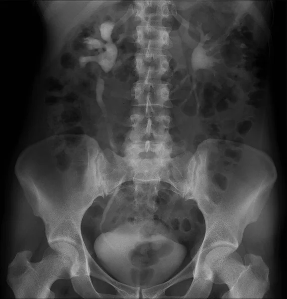 Radiografía Del Abdomen Hidronefrosis Derecha Pieloectasia Izquierda — Foto de Stock