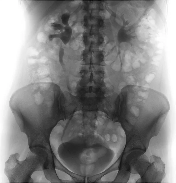 선입니다 Hydronephrosis 권리입니다 Pyeloectasia 왼쪽입니다 네거티브 — 스톡 사진