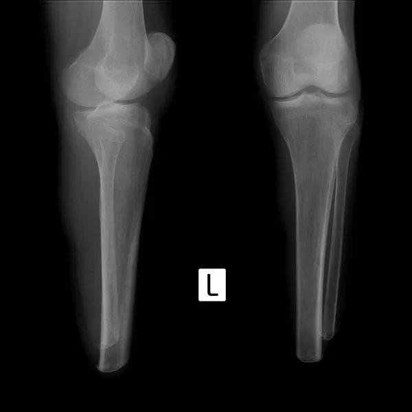 Рентген Голени Пень Левой Голени — стоковое фото