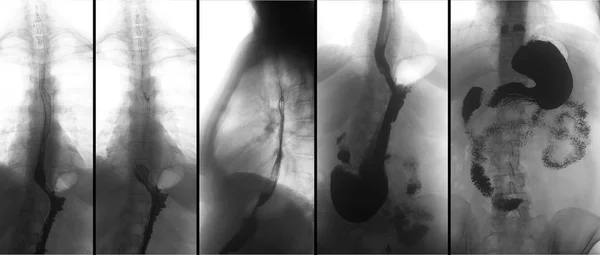 Röntgenfoto Van Bovenste Gastro Intestinale Tractus Ugi Met Barium Hiatal Rechtenvrije Stockafbeeldingen