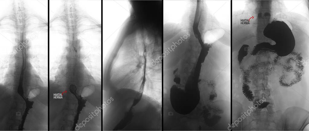 X-ray of the upper gastrointestinal tract (UGI) with barium. Hiatal hernia. Negative. Marker.