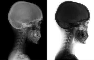 X-ray of the cervical spine. Kimerly anomaly. Cervical dysfunction. Negative.  clipart