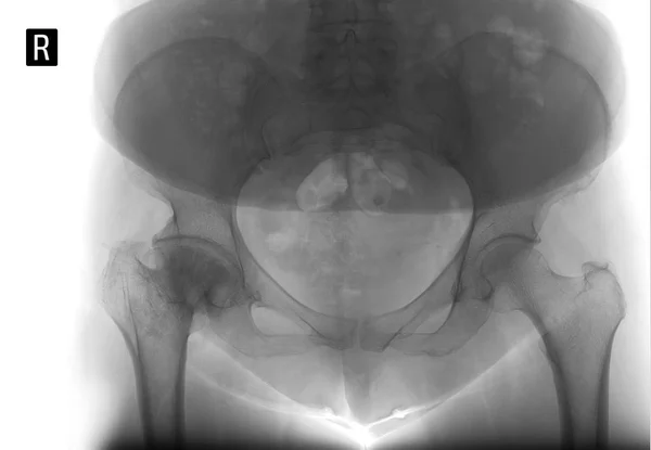 Radiografía Pelvis Artrosis Deformante Articulación Cadera Derecha Necrosis Aséptica Cabeza — Foto de Stock