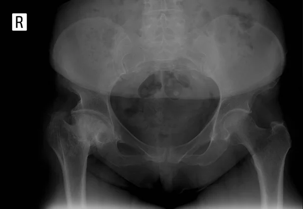 X-ışını leğen. Sağ kalça eklemi artroz bozulmayı. Femur başı aseptik nekrozu. 