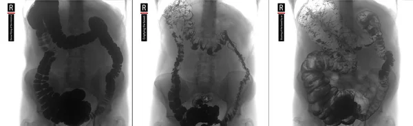 X-ray of the lower parts of the gastrointestinal tract (GI). Tight filling. Emptying. Insufflation by air. Dolichocolon. Negative.