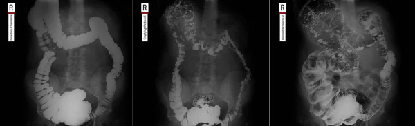 Raio Das Partes Inferiores Trato Gastrointestinal Enchimento Apertado Esvaziar Insuflação — Fotografia de Stock