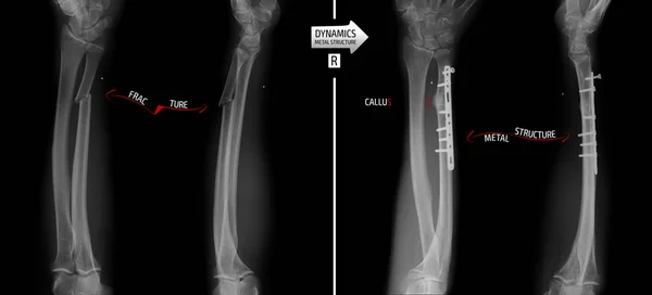 Radiografía Los Huesos Del Antebrazo Fractura Del Cúbito Con Reposición —  Fotos de Stock