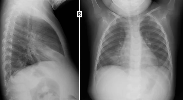 Ακτινογραφία Των Πνευμόνων Παιδί Πνευμονία Στον Δεξιό Πνεύμονα Αρνητική — Φωτογραφία Αρχείου