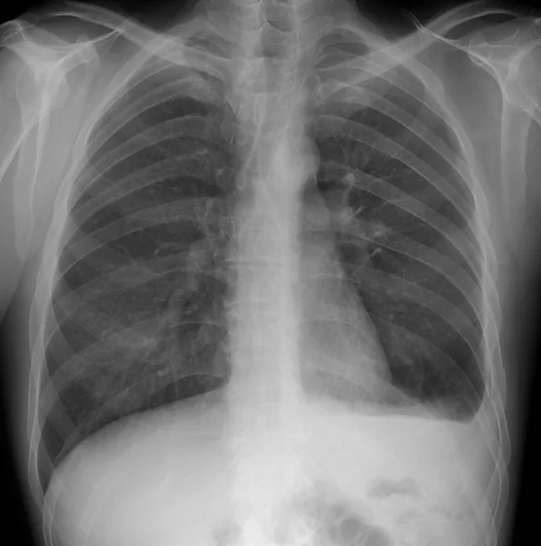 Radiographie Pulmonaire Hémothorax Fractures Côte Gauche — Photo