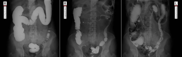 Raio Das Partes Inferiores Trato Gastrointestinal Enchimento Apertado Esvaziar Insuflação — Fotografia de Stock