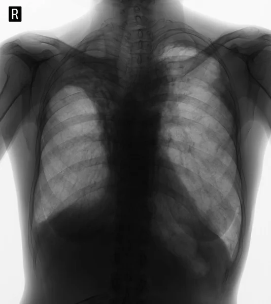 Raio Dos Pulmões Pneumofibrose Postradiação Negativo — Fotografia de Stock