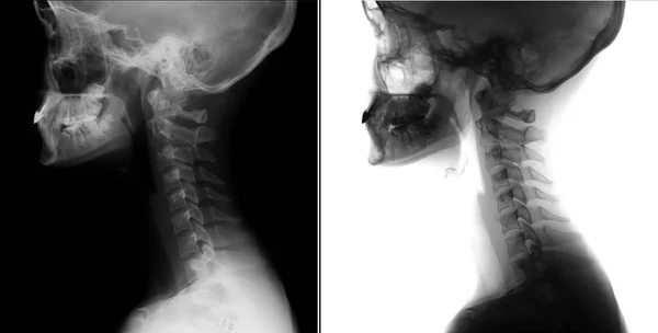 Radiografía Columna Cervical Anomalía Kimerly Negativo — Foto de Stock