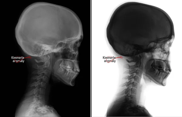 颈椎的 金基异常 颈椎功能障碍 — 图库照片