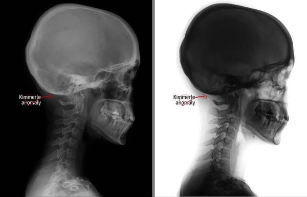 Servikal Omurga Röntgeni Kimerly Anomali Servikal Disfonksiyon Olumsuz Marker — Stok fotoğraf